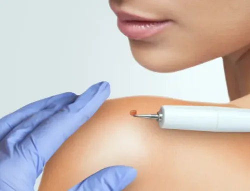 مرکز خال برداری در کرج | خال برداری با لیزر | بهترین کلینیک خال برداری در کرج