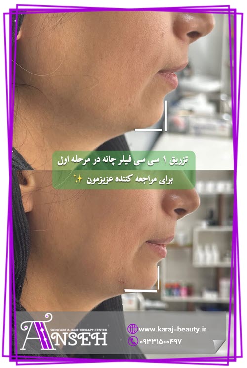 نمونه کار تزریق ژل چانه در کرج | کلینیک آنسه