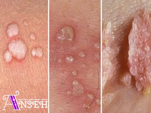 مرکز برداشت زگیل در کرج | انسه
