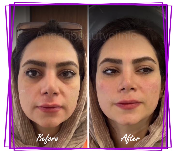 عکس فیلر و ژل گونه قبل و بعد از تزریق | کلینیک آنسه