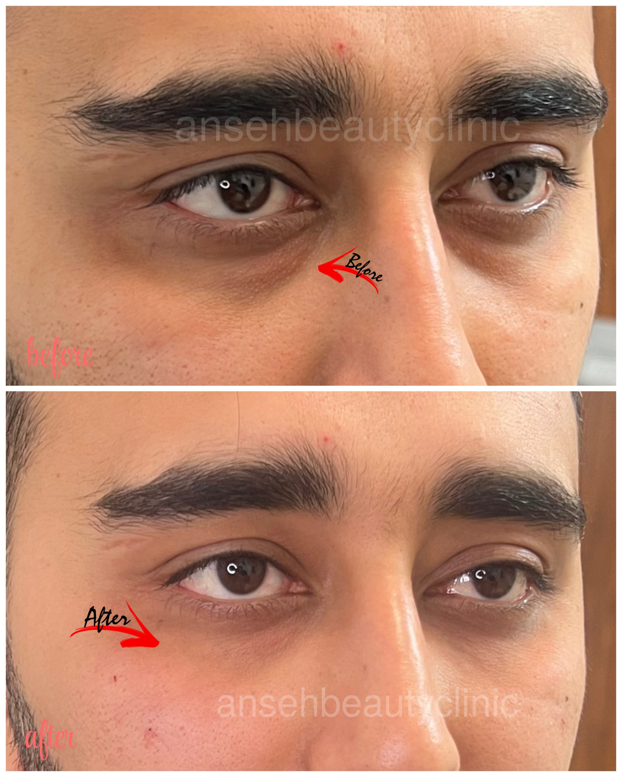از بین بردن گودی زیر چشم