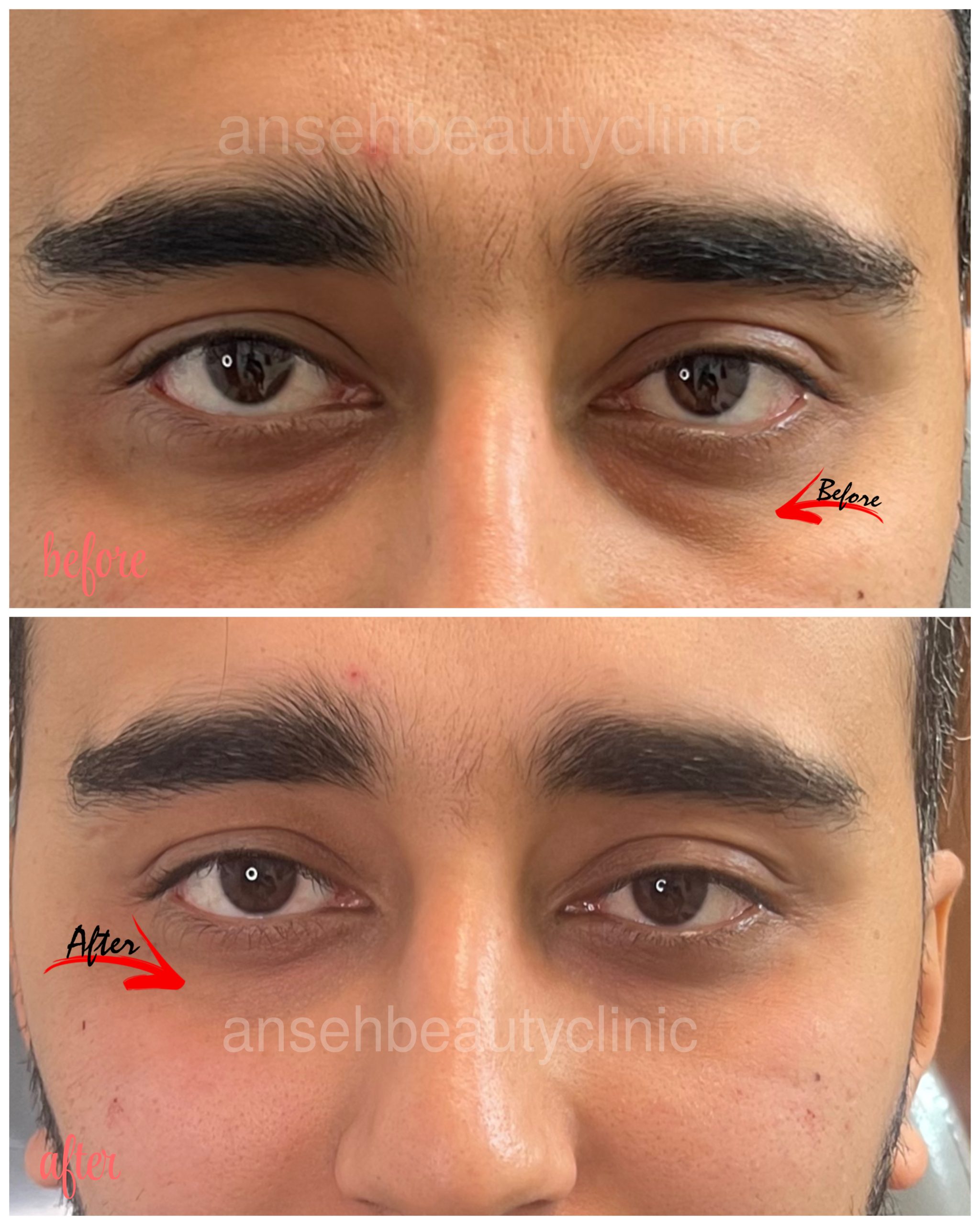 فیلر زیر چشم
