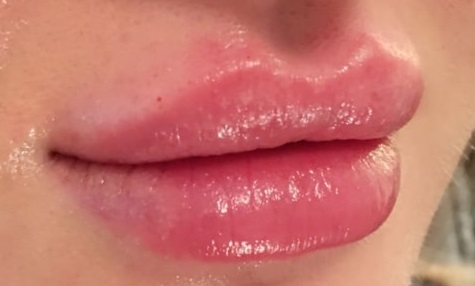 عکس ژل لب عروسکی، تزریق ژل لب عروسکی در کرج