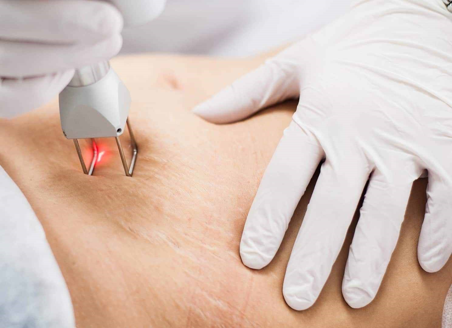 برای رفع ترک های پوستی، از چه روشی استفاده کنیم؟