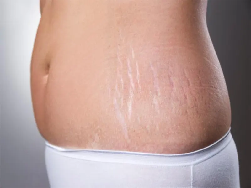 برای رفع ترک های پوستی، از چه روشی استفاده کنیم؟