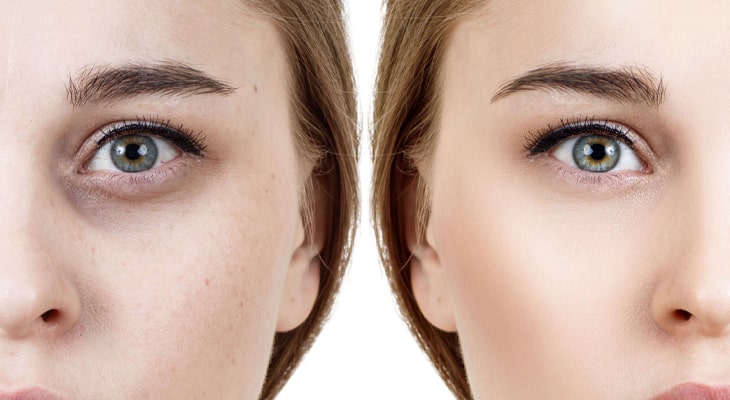 10روش خانگی برای رفع تیرگی زیر چشم