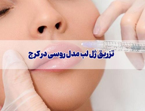 دکتر خوب برای تزریق ژل لب روسی در کرج/ نمونه کار در پیج اینستاگرام