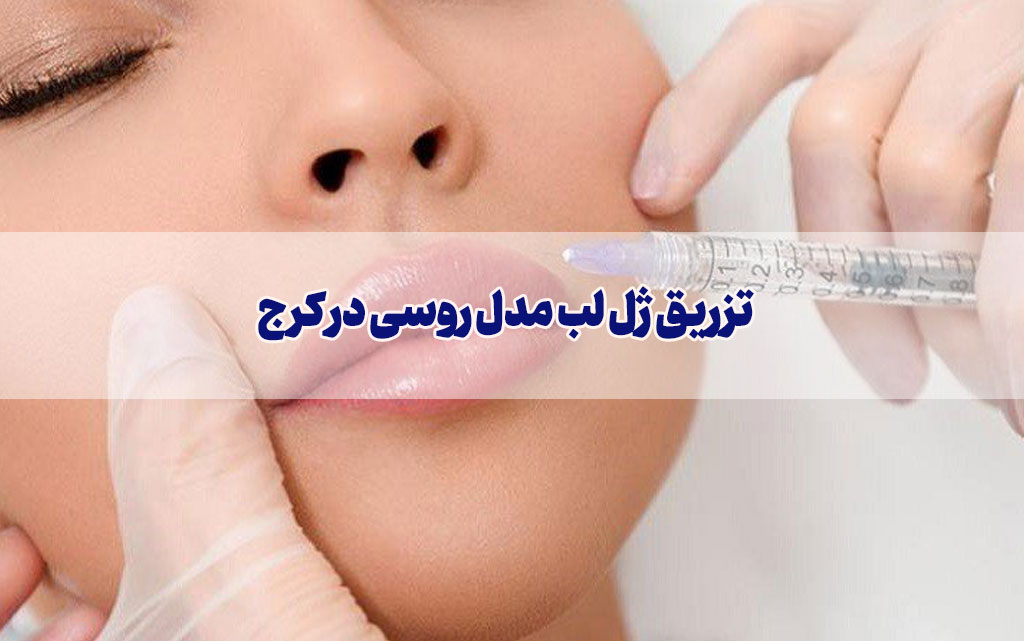 دکتر خوب برای تزریق ژل لب روسی در کرج