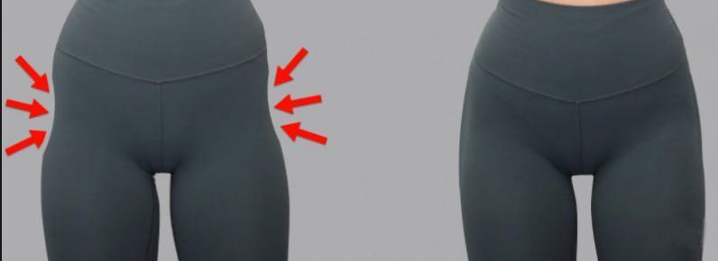 تزریق چربی به گودی بغل ران