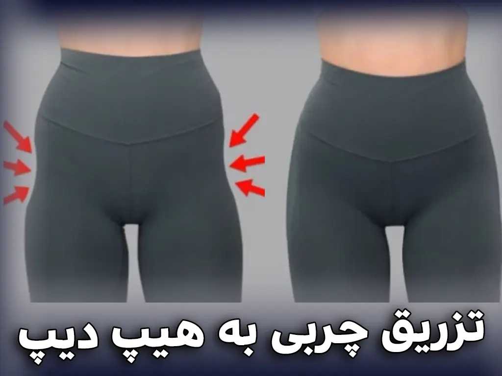 تزریق چربی به هیپ دیپ در کرج