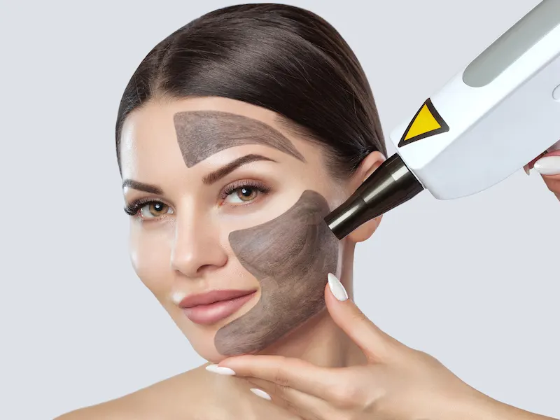 لایه برداری کربن در کرج با کیوسوییچ