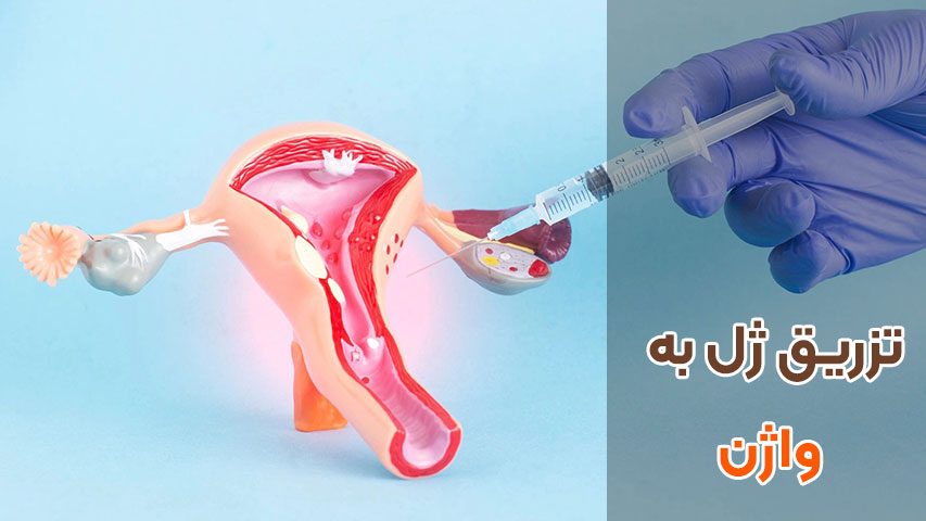 تزریق ژل به واژن در کرج