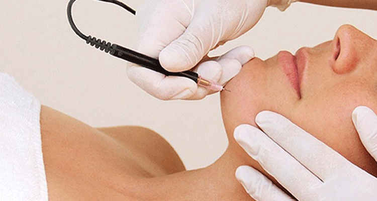 هزینه لیزر موهای سفید صورت در کرج