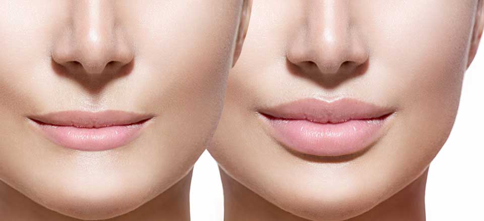 تفاوت ژل با فیلر چیست؟