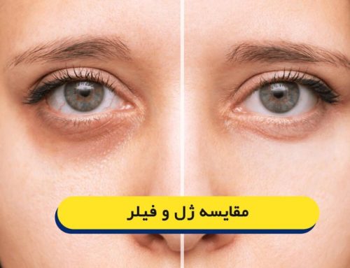 تفاوت ژل با فیلر چیست؟