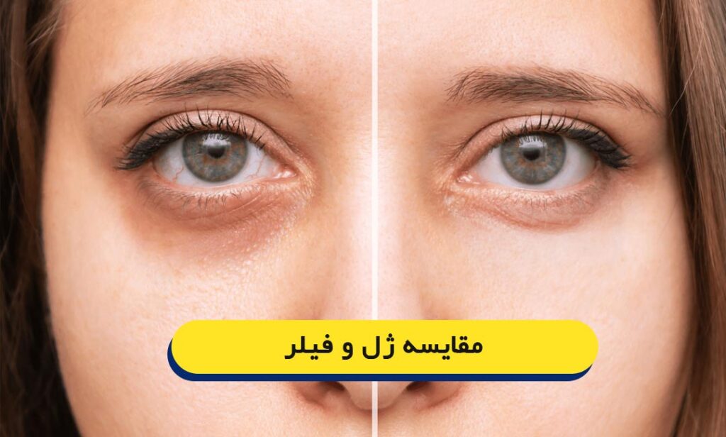 تفاوت ژل با فیلر چیست؟