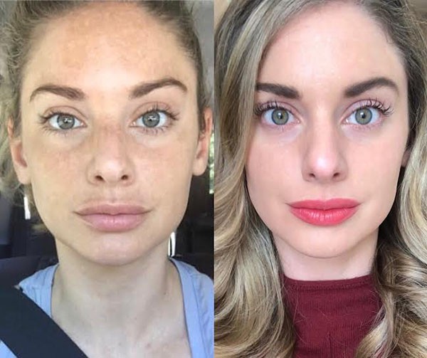 مراقبت‌های بعد از میکرونیدلینگ برای جلوگیری از لک