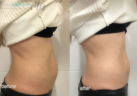 چطور بدون ورزش لاغر شویم؟ آیا روش دیگری به غیر از ورزش برای لاغری هست؟