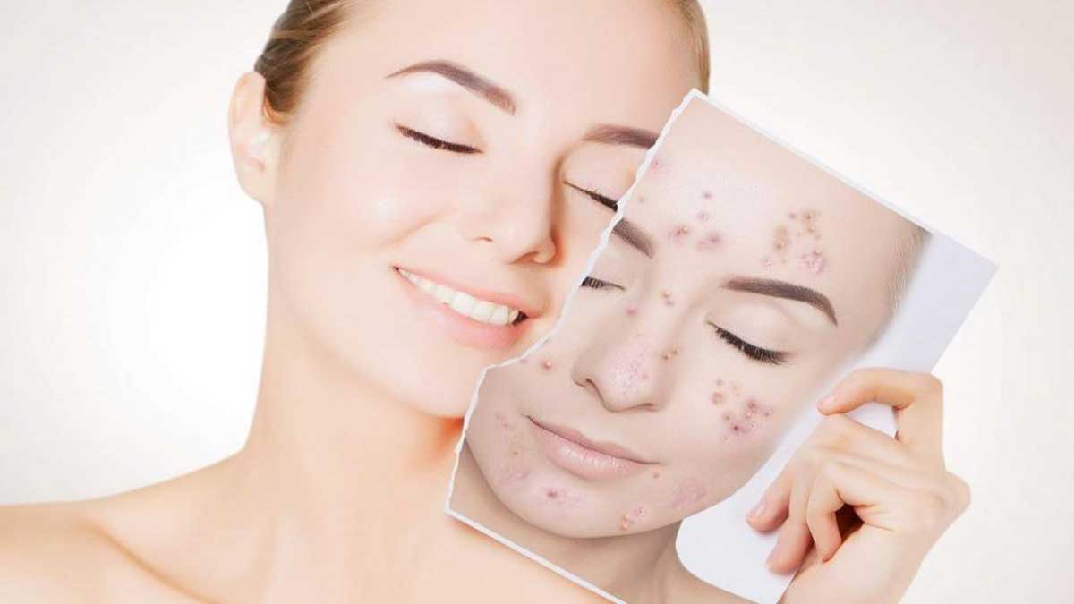 نکات مراقبتی پس از پی آر پی صورت برای جوانسازی