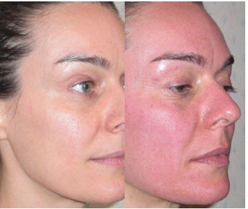 تفاوت میکرونیدلینگ با مزونیدلینگ چیست؟