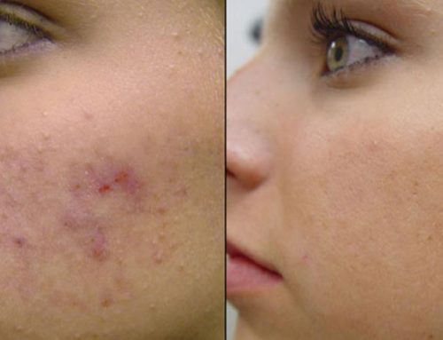 تاثیر آر اف بهتر است یا میکرونیدلینگ؟؟