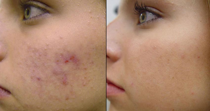 آر اف بهتر است یا میکرونیدلینگ؟؟