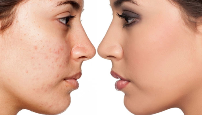 روشهای پزشکی موثر در از بین بردن جای جوش