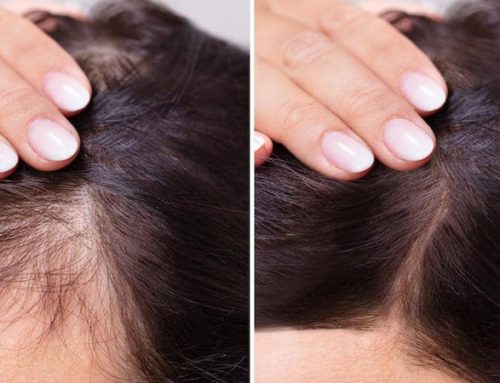 بهترین قرص برای بعد از کاشت مو کدام است؟