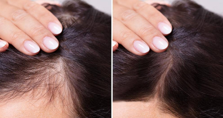 بهترین قرص برای بعد از کاشت مو