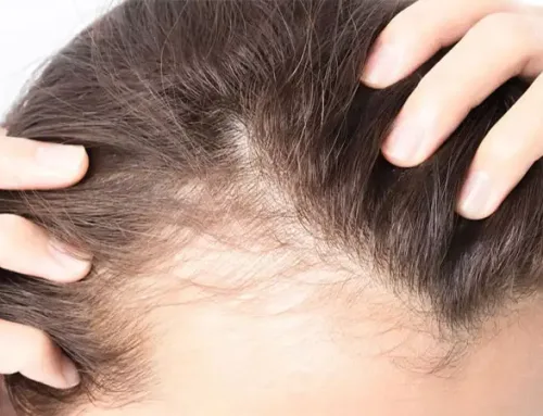 بهترین روش های تقویت مو بعد از کاشت مو چیست؟