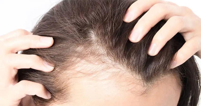 تقویت مو بعد از کاشت مو