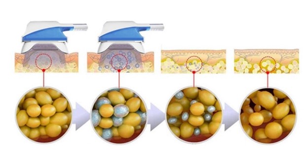 لاغری با دستگاه کرایو لیپولیز در کرج
