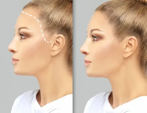 آیا کاشت مو برای زنان موثر است؟