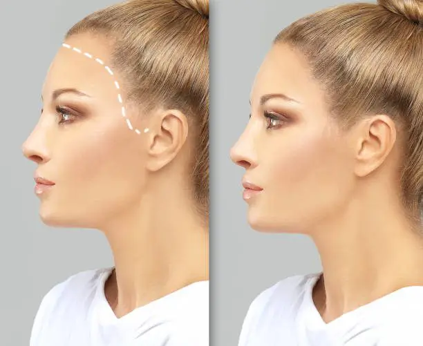 کاشت مو برای زنان