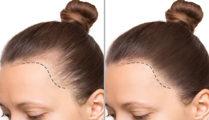 کاشت مو برای زنان خوب است؟