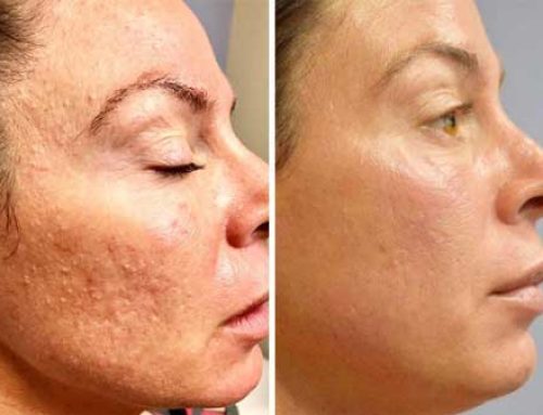 تفاوت میکرونیدلینگ با مزونیدلینگ چیست؟