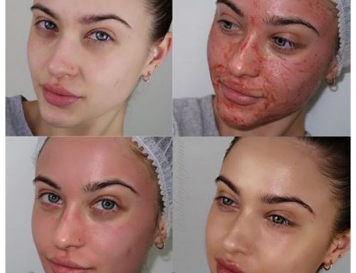 آیا بعد از میکرونیدلینگ احتمال لک شدن وجود دارد؟