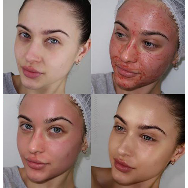 بررسی لک بعد از میکرونیدلینگ