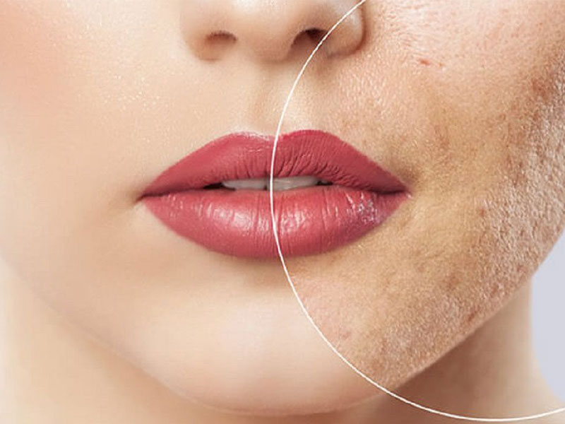 بهترین راه های از بین بردن جای جوش کدام است؟