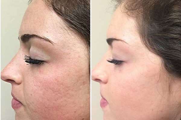 تاثیر آر اف بهتر است یا میکرونیدلینگ؟؟