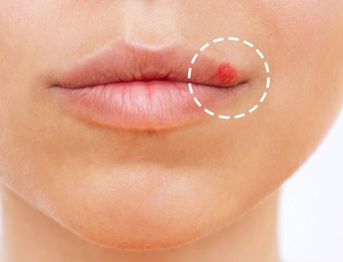 ده روش درمان خانگی زگیل پوستی