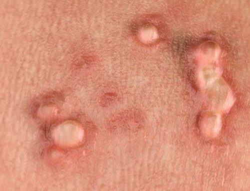 زگیل تناسلی چیست؟ برای از بین بردن زگیل تناسلی چکار کنیم؟