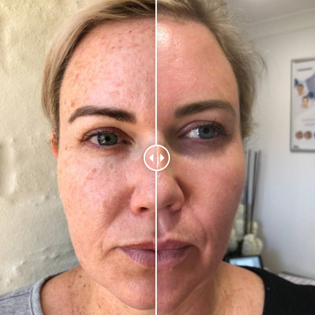 مزونیدلینگ یا میکرونیدلینگ