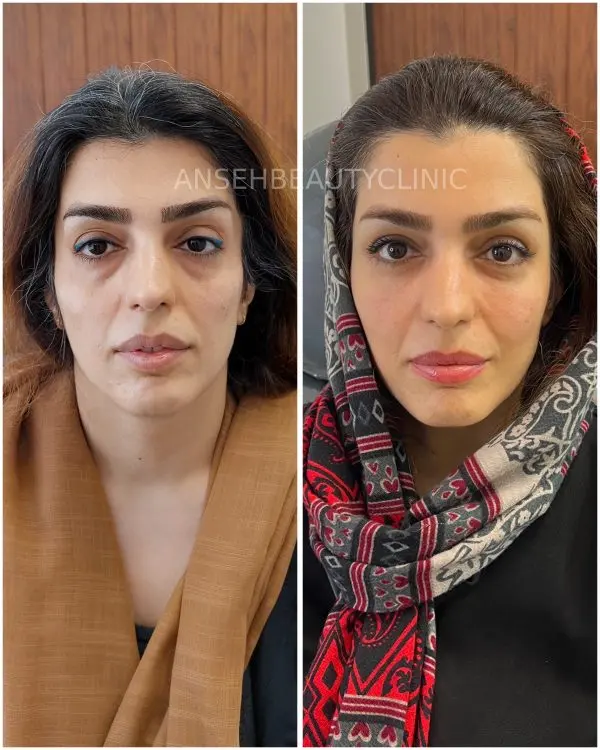 تزریق فیلر فول فیس در کلینیک آنسه کرج