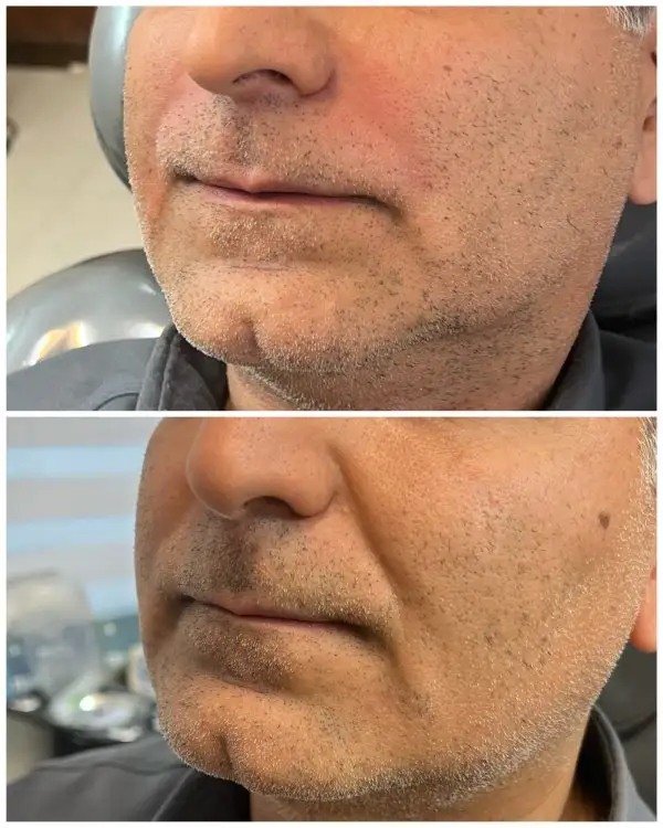 تزریق فیلر خط خنده