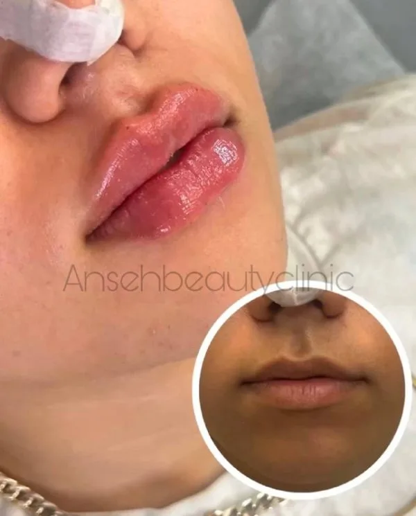 تزریق فیلر لب کرج