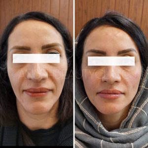 تزریق ژل برای جوانسازی 