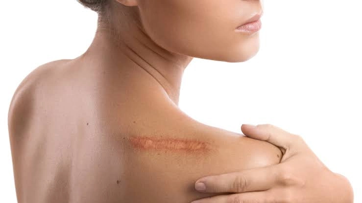 از بین بردن جای زخم و بخیه