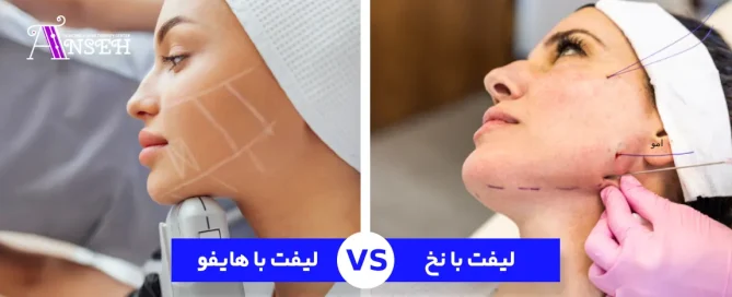 لیفت صورت با نخ بهتره یا هایفوتراپی؟