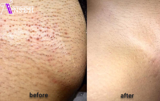 لیزر پشت ران در کلینیک آنسه